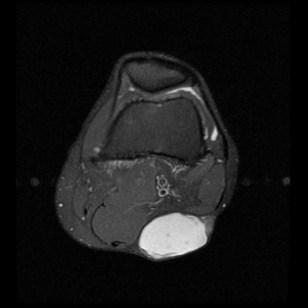 inclusion cysts