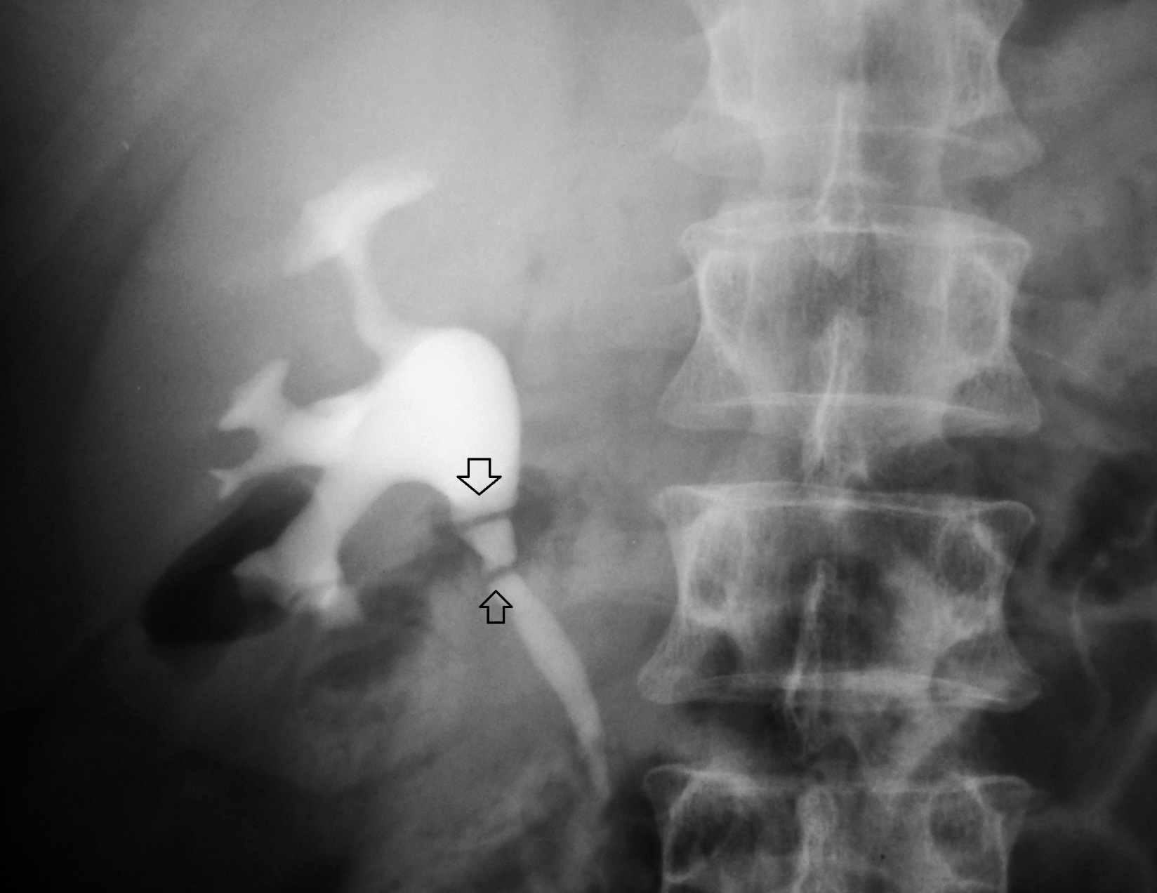 What Is An Intravenous Pyelogram Ivp