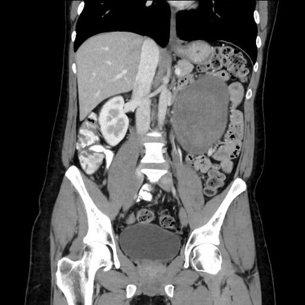 Mesenteric desmoid tumor | Image | Radiopaedia.org