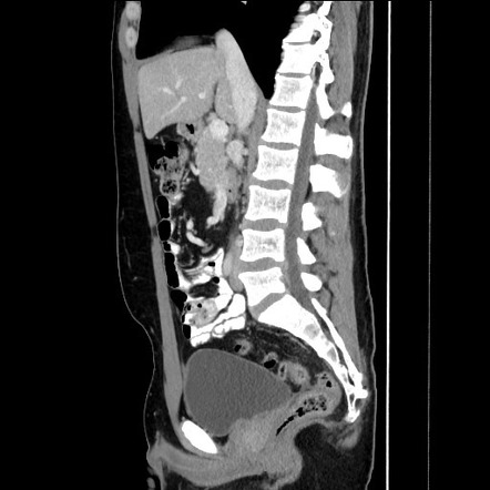 Mesenteric desmoid tumor | Image | Radiopaedia.org