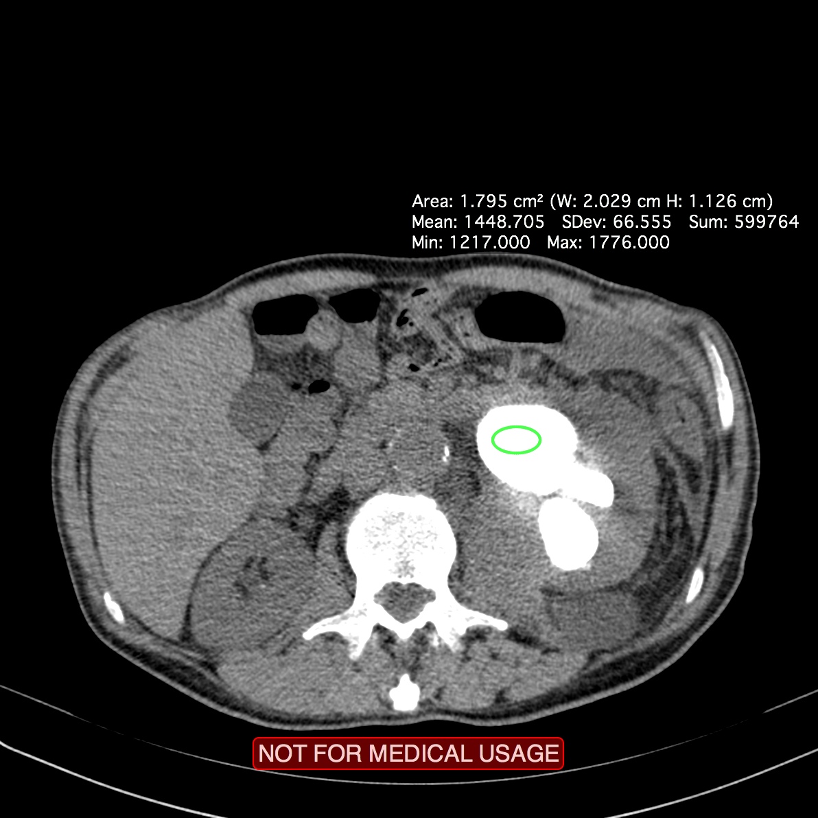 Xanthogranulomatous Pyelonephritis | Image | Radiopaedia.org