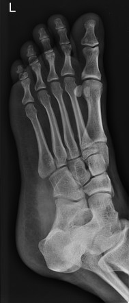 Extensor digitorum brevis avulsion | Image | Radiopaedia.org