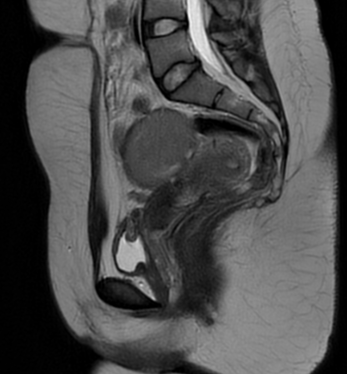 Ovarian Endometrioma Hemorrhagic Cyst Image 9717