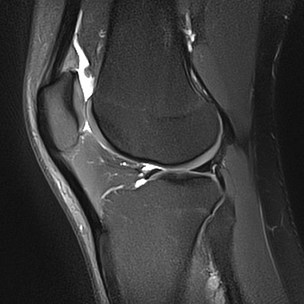 Quadriceps fat pad impingement syndrome | Radiology Reference Article