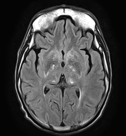 Fahr syndrome - MRI | Image | Radiopaedia.org