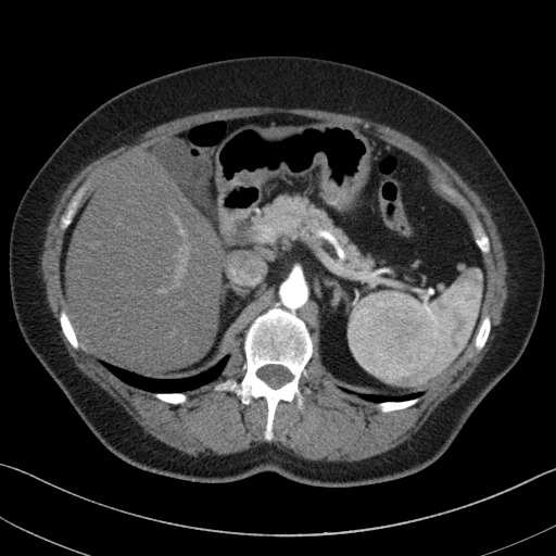 Splenic hamartoma | Image | Radiopaedia.org