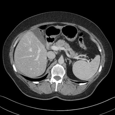 Splenic hamartoma | Radiology Case | Radiopaedia.org