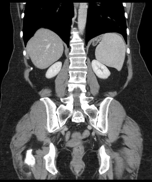 Splenic hamartoma | Image | Radiopaedia.org