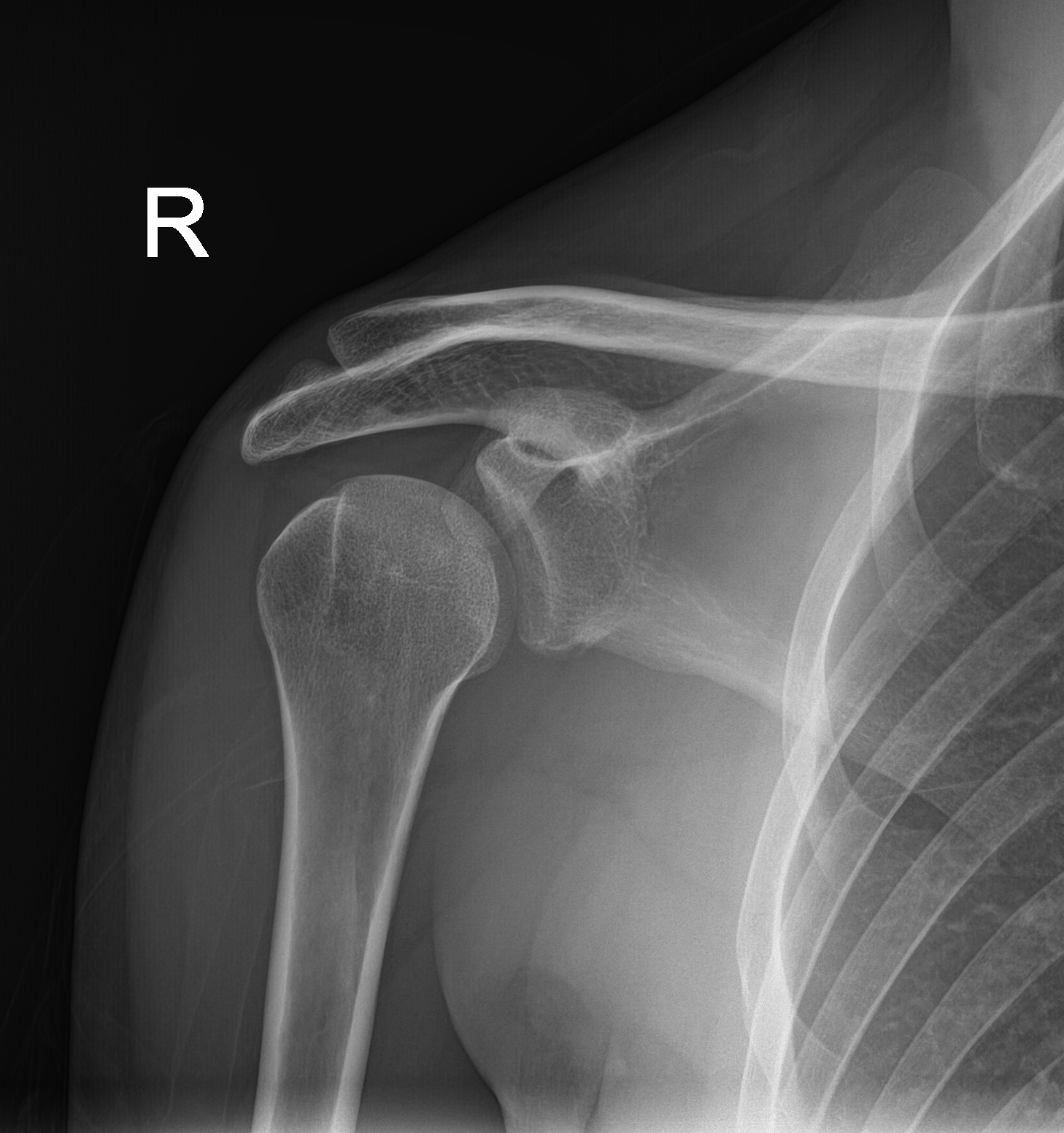 Posterior shoulder dislocation | Image | Radiopaedia.org