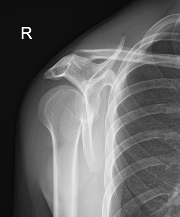 Posterior shoulder dislocation | Image | Radiopaedia.org