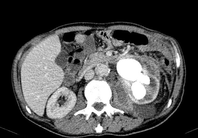 Xanthogranulomatous Pyelonephritis | Radiology Reference Article ...