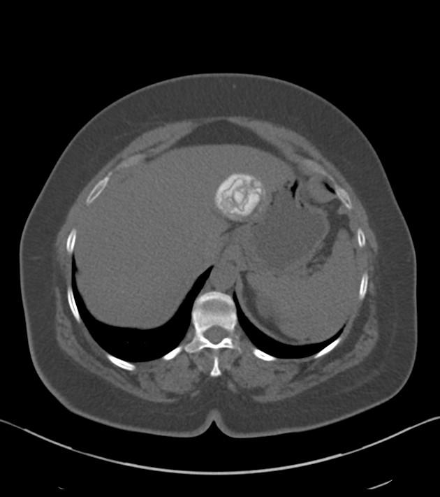 Calcified hepatic hydatid cyst | Image | Radiopaedia.org