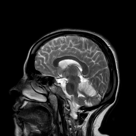 Superior cerebellar artery territory infarction | Image | Radiopaedia.org