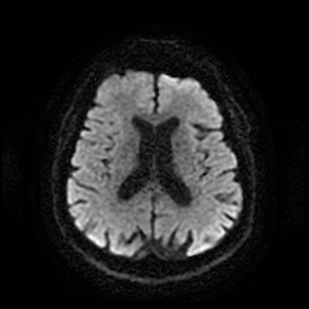 Negative quick stroke protocol MRI | Radiology Case | Radiopaedia.org