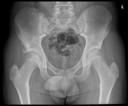 Anterior inferior iliac spine avulsion fracture | Radiology Case ...