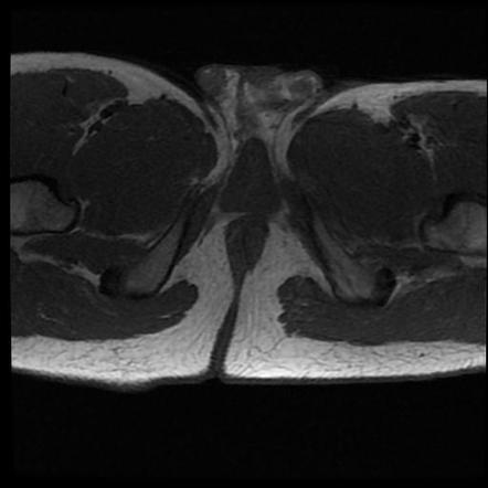 Pilonidal sinus (intergluteal) | Image | Radiopaedia.org