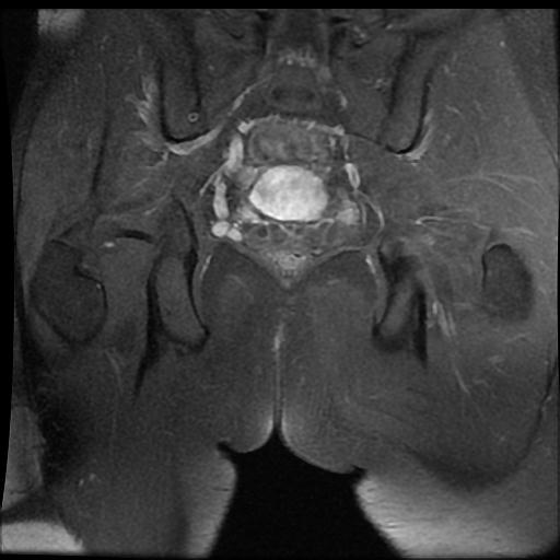 Pilonidal sinus (intergluteal) | Image | Radiopaedia.org