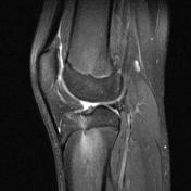 Focal periphyseal edema zone | Radiology Reference Article ...