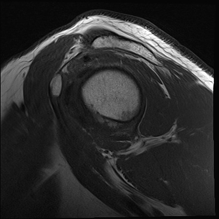 Full thickness supraspinatus tear | Image | Radiopaedia.org