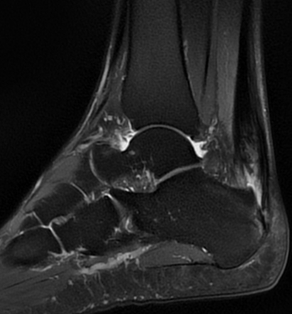 Achilles tendon tear | Radiology Case | Radiopaedia.org