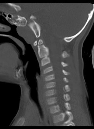 Atlanto-occipital assimilation associated with atlanto-axial rotatory ...