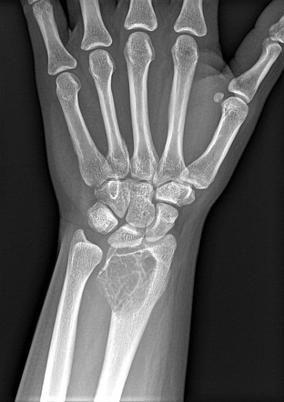 Viewing playlist: 26. Bone tumors | Radiopaedia.org