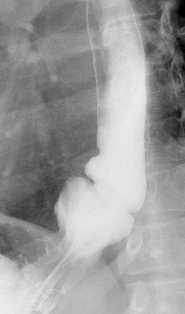 Diseases of the Esophagus: Diagnosis with Esophagography | Radiology