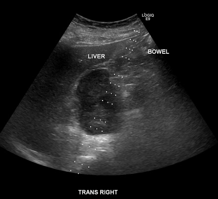 Ultrasound-guided biopsy | Radiology Reference Article | Radiopaedia.org