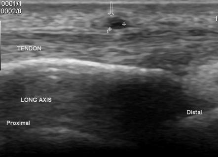 De Quervain tenosynovitis | Radiology Case | Radiopaedia.org