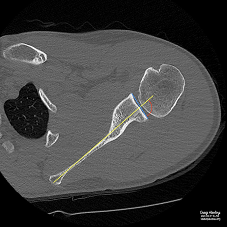 Glenoid retroversion | Radiology Reference Article | Radiopaedia.org