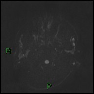 Unilateral occipital plagiocephaly | Image | Radiopaedia.org