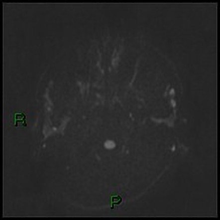 Unilateral occipital plagiocephaly | Image | Radiopaedia.org