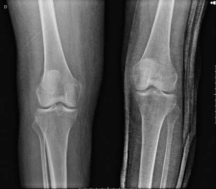 Pathologic fractures due to breast cancer metastasis | Image ...