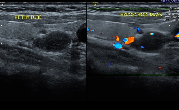 Parathyroid adenoma | Radiology Reference Article | Radiopaedia.org