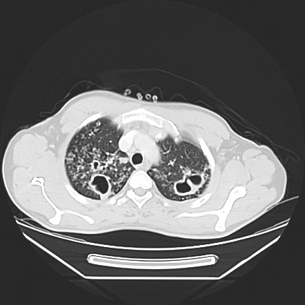 Post-primary pulmonary tuberculosis | Radiology Reference Article ...