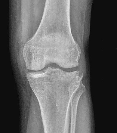 ACL avulsion and Segond fracture | Radiology Case | Radiopaedia.org