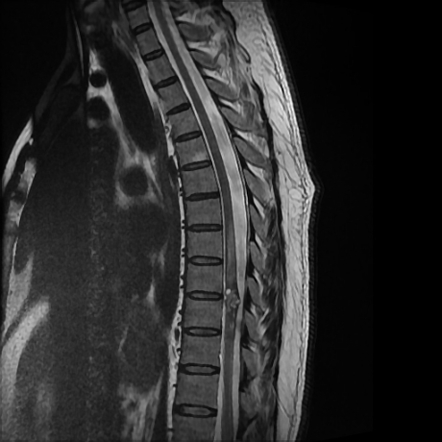 Spinal cord cavernous malformation | Radiology Reference Article ...