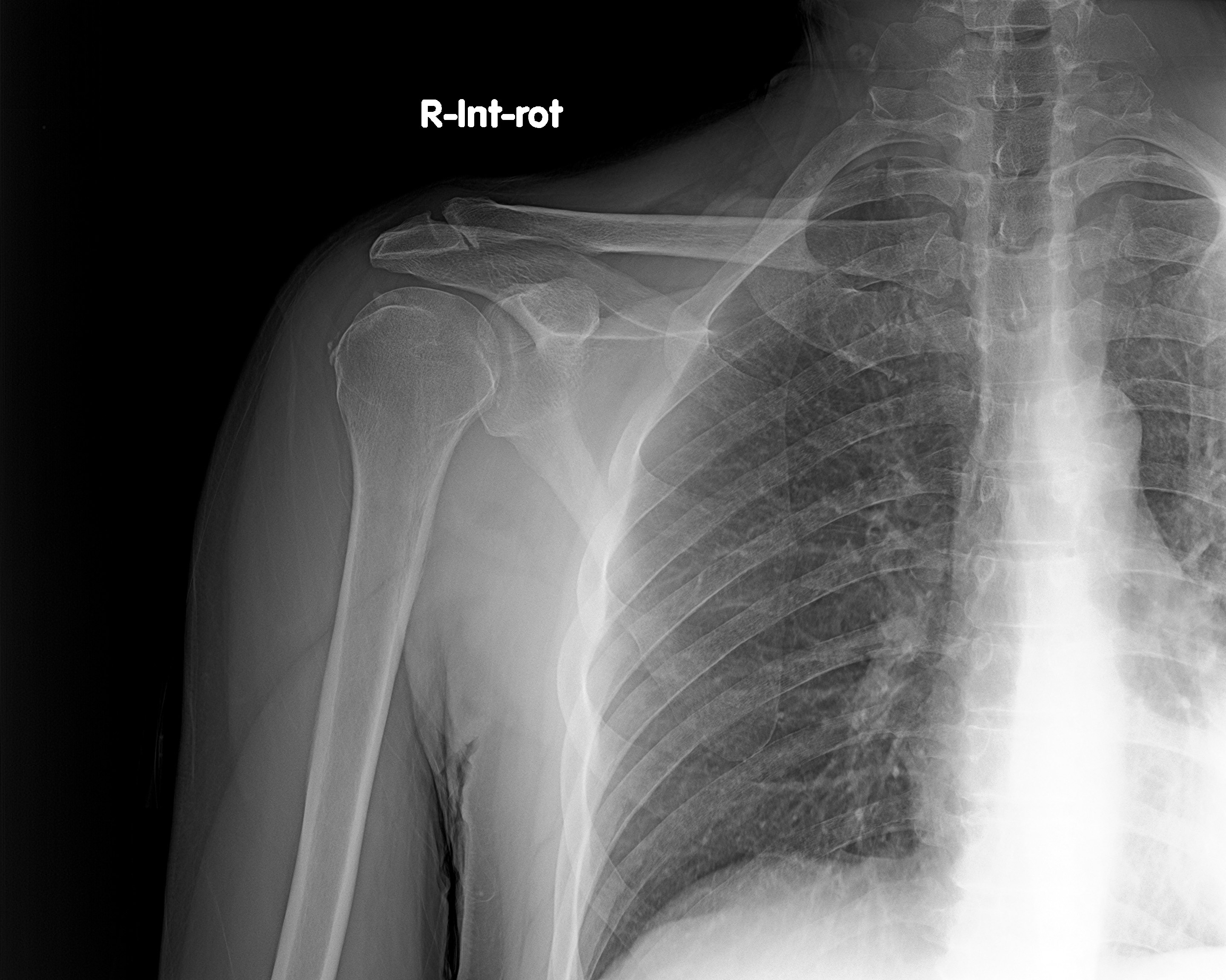 Bilateral Calcific Tendinitis - Supraspinatus Tendon | Image ...