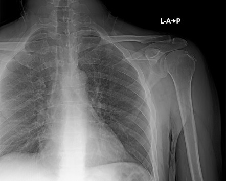 Bilateral calcific tendinitis - supraspinatus tendon | Image ...