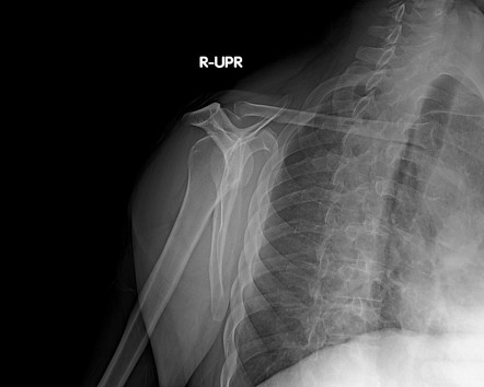 Bilateral Calcific Tendinitis Supraspinatus Tendon Image