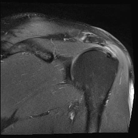 Bilateral Calcific Tendinitis - Supraspinatus Tendon 