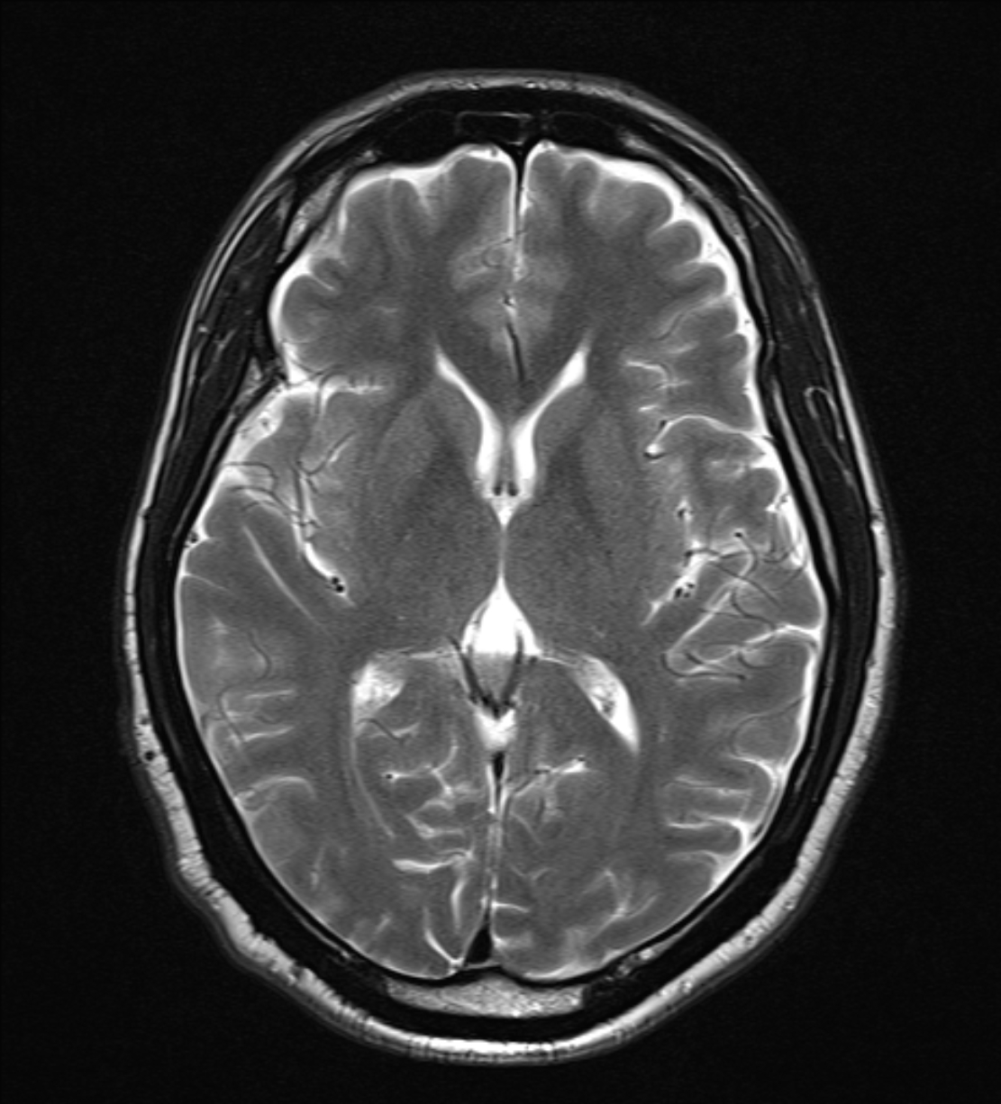 Arachnoid Cyst Of The Ambient Cistern 