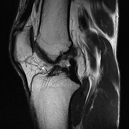 Anterior cruciate ligament complete tear | Image | Radiopaedia.org