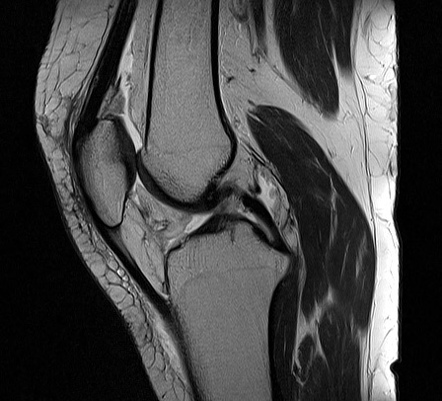 Patellar chondral avulsion fracture | Image | Radiopaedia.org