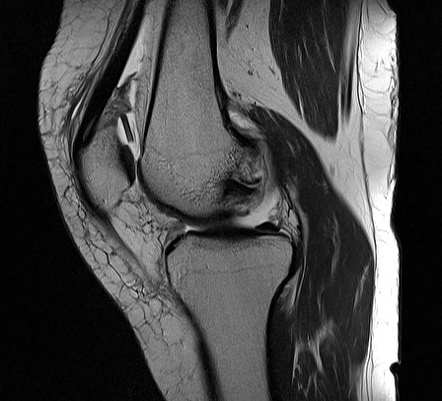 Patellar Sleeve Fracture 