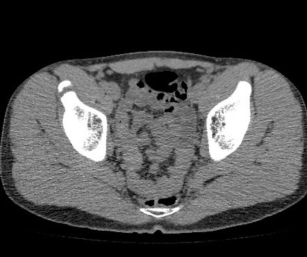 Anterior inferior iliac spine avulsion fracture | Image | Radiopaedia.org