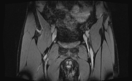 Anterior inferior iliac spine avulsion fracture | Image | Radiopaedia.org