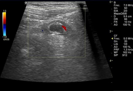 Acute Appendicitis | Radiology Case | Radiopaedia.org