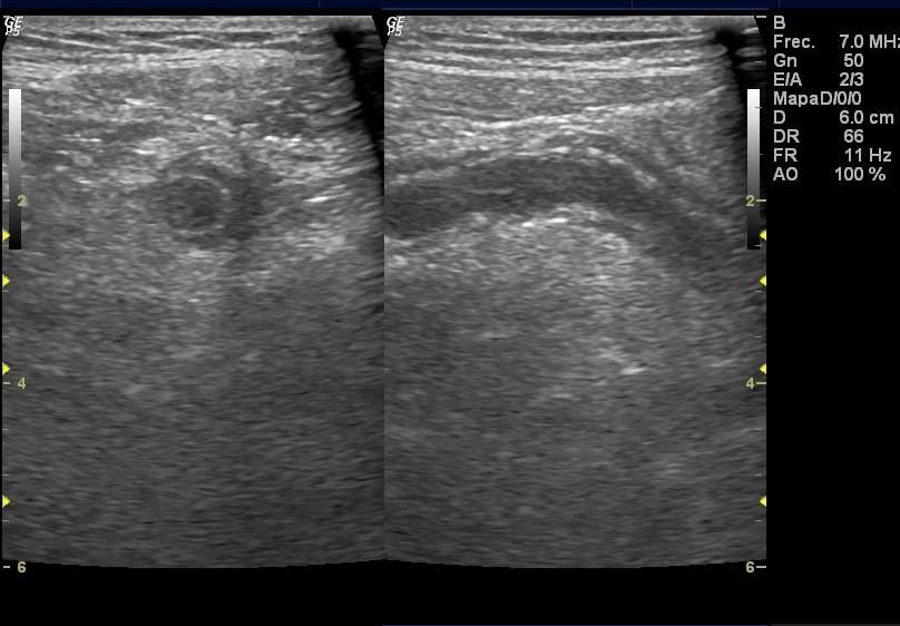 Acute Appendicitis | Image | Radiopaedia.org