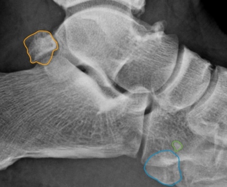 Os trigonum and unfused apophysis of the proximal 5th metatarsal ...